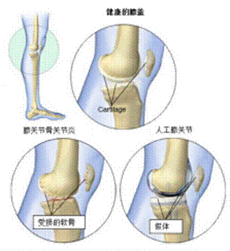 26项临床实验证明，间充质干细胞治疗膝骨关节炎有效，其疗法已经成功上市