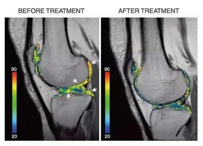 26项临床实验证明，间充质干细胞治疗膝骨关节炎有效，其疗法已经成功上市