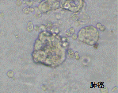 医学药筛新变革｜世界首例由实体瘤癌症患者为来源的类器官，成功筛选到临床候选药物！